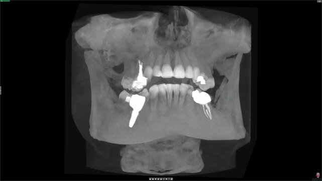 Animation of a dental MRI software screen. Monitoring dental health using a skull scan. Dental examination. Dental implant placement