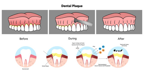 Hand-drawn dental infographic illustrating the formation of dental plaque on tooth anatomy. Includes enamel, dentin, pulp, gum line, and bacterial buildup area