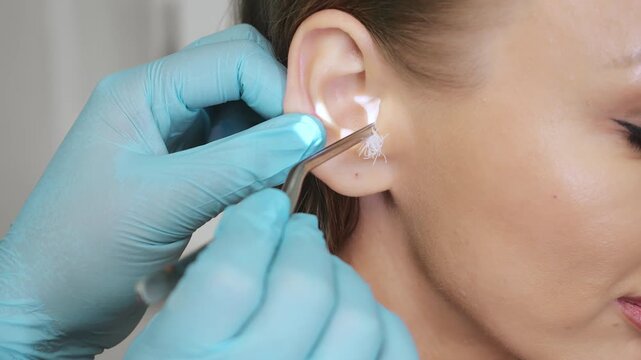 ENT doctor inserting gauze wick into patient ear canal during ear treatment in medical clinic with close up focus on procedure.