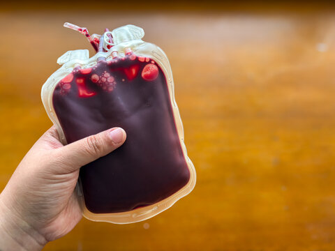 Nurse hand holding blood bag for medical transfusion procedure