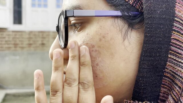 A girl applying skin care cream on her face as her face is full of dark spots red burn spots bumps and pimples. Girl applying face cream closeup footage 