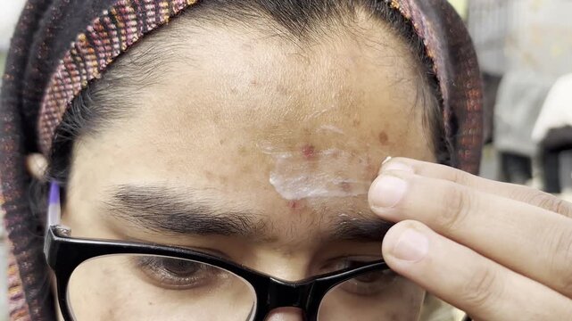 A girl applying skin care cream on her face as her face is full of dark spots red burn spots bumps and pimples. Girl applying face cream closeup footage 