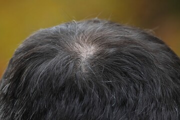 Man head with hair loss