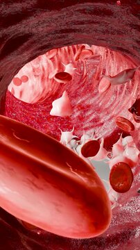 Hemostasis. Red blood cells and platelets in the blood vessel, vasoconstriction, wound healing process. hemorrhage clot embolisms, Hemophilia. fibrinolysis, injury bleeding coagulation, 3d render