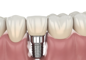 Restorative dental implant for a healthy smile
