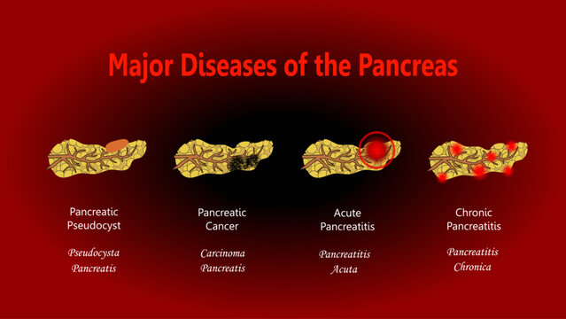 Major Diseases of the Pancreas, diagram with Latin names