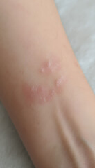 Fototapeta premium Close-Up Forearm Skin Irritation Showing Sensitivity and Inflammation in Natural Light
