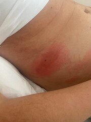 Naklejka premium Allergic Reaction to Bee Sting – Swelling and Redness on Skin