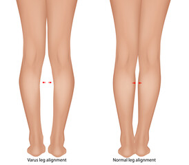 Detailed medical illustration comparing varus leg alignment  with normal leg alignment. Genu Varum Comparison with Normal Lower Limb Anatomy
