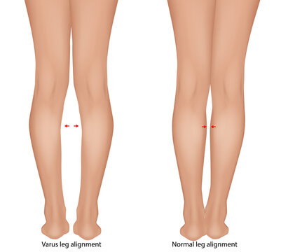 Detailed medical illustration comparing varus leg alignment  with normal leg alignment. Genu Varum Comparison with Normal Lower Limb Anatomy