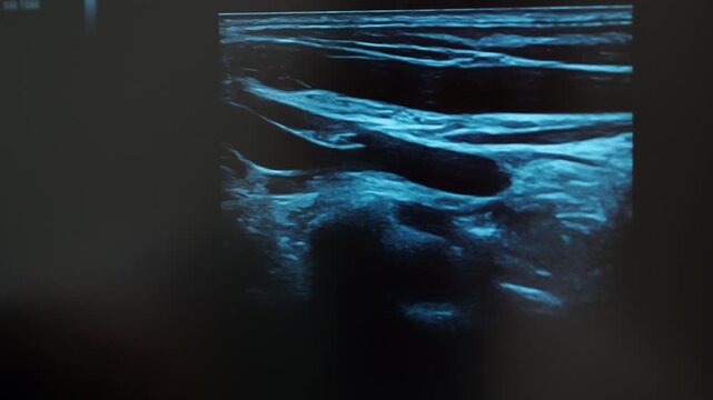 Close up of doctor pointing at thyroid ultrasound image on medical monitor during diagnostic examination in modern clinic, healthcare imaging and endocrine analysis.
