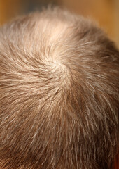 A man's head with a bald spot