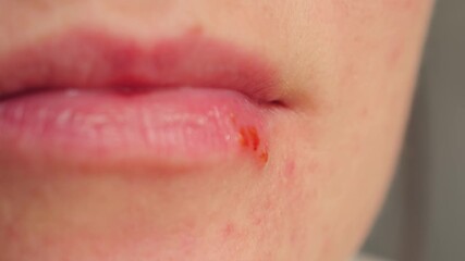 Close-up of lips girl with herpes. Appearance of herpes signs of weakened immunity. High quality 4k footage