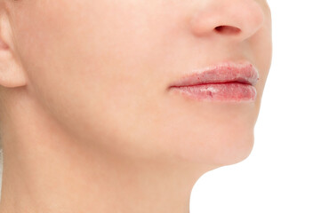 A woman's face with injection marks and bruises after a lip augmentation procedure.