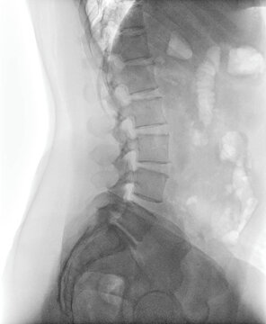 Lumbar spine x-ray showing vertebrae and intervertebral spaces. Lateral view plain film radiograph for diagnostic examination of lower back anatomy and alignment