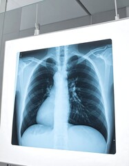 Close-up of a chest X-ray, showcasing human anatomy