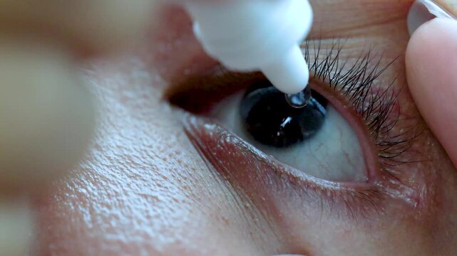 Close-Up of Eye Drop Application for Irritation Relief