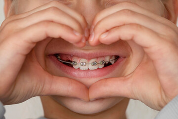 Dental Braces on Baby Teeth.  Aligning teeth for Children. Teeth alignment. Orthodontic treatment