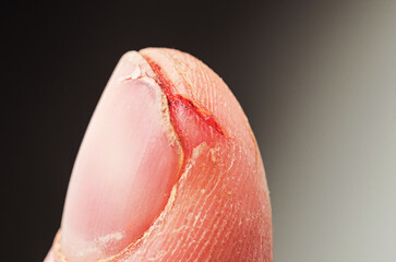 Close-up of a cut on a finger with blood, showing injury and pain