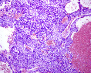 Urinary bladder. Transitional cell carcinoma