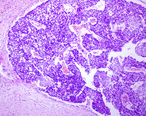 Urinary bladder. Transitional cell carcinoma