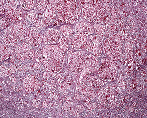 Obraz premium Superior cervical ganglion. Ganglioneuroma