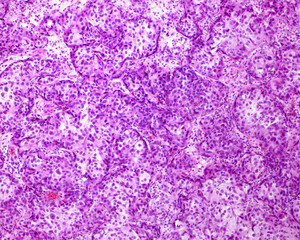 Urinary bladder. Transitional cell carcinoma