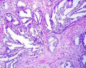 Human prostate. Cribriform cancer