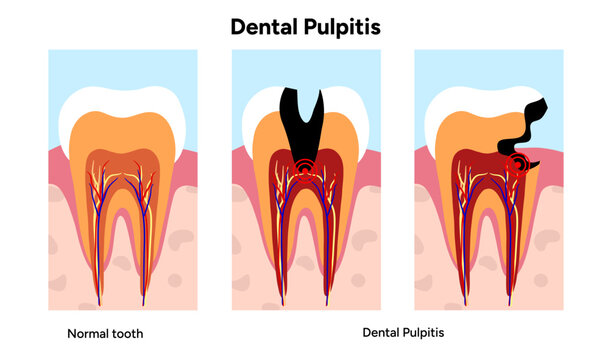Hand-drawn dental infographic of pulpitis anatomy, inflamed tooth pulp, root canals, and internal structure. Educational illustration ideal for dental clinics, oral health guides, medical posters