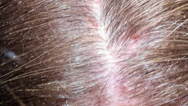 A close-up of dirty, unkempt hair with dandruff and damaged scalp. Fungal skin infections.