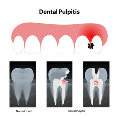 Hand-drawn dental infographic dental pulpitis with X-ray. Educational illustration tooth, inflamed pulp, and dental issues