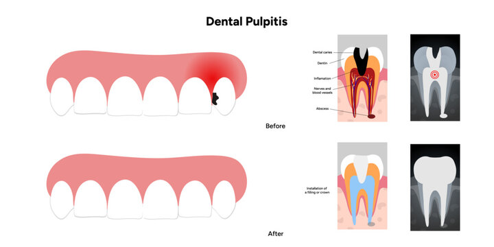 Hand-drawn dental infographic of dental pulpitis anatomy, root canal treatment, and X-ray view. Educational illustration for dentistry