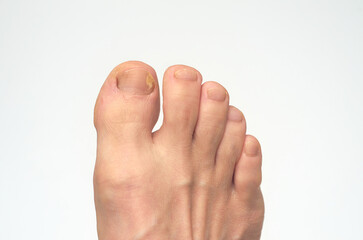남성의 발톱 무좀 클로즈업 흰색배경