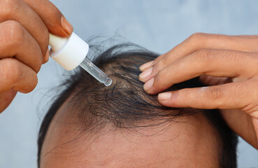 Naklejka premium An Asian man is dripping with pipette a hair nourishing serum on a thinning head area. Focus on the head. 