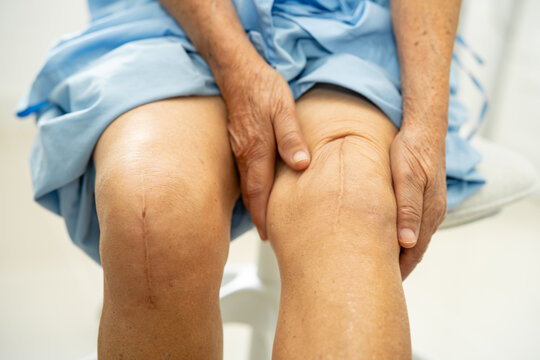 Asian elderly woman patient show her scars surgical total knee joint replacement.