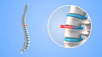 Chronic Back Pain Due to Spinal Disc Bulge
