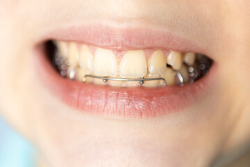 Smiling child showcasing dental braces with a happy expression in a bright setting