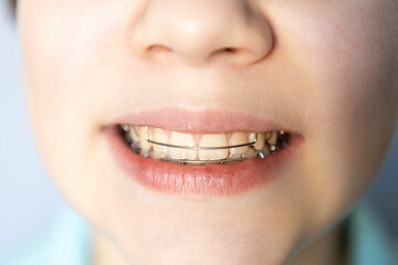 Orthodontic treatment with braces on teeth during adjustment for better alignment and smile improvement