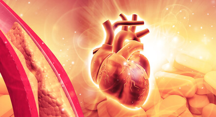 Blood vessel blockage, Heart attack, coronary artery disease and atherosclerosis condition. 3d illustration