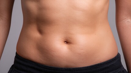 Postpartum Belly Featuring Stretch Marks and Loose Fat Displayed Against a Neutral Background for Medical Aesthetics Presentation