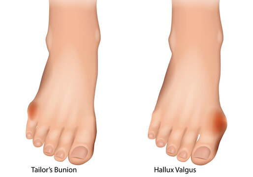 Tailor&rsquo;s Bunion bunionette and Hallux Valgus Medical Illustration. Foot Deformities Comparison. Bunionette and Hallux Valgus