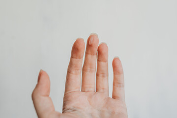 Close-up of a woman’s hand with skin irritation on the finger — real skin texture, dermatology concept