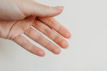 Close-up of a woman’s hand with skin irritation on the finger — real skin texture, dermatology concept