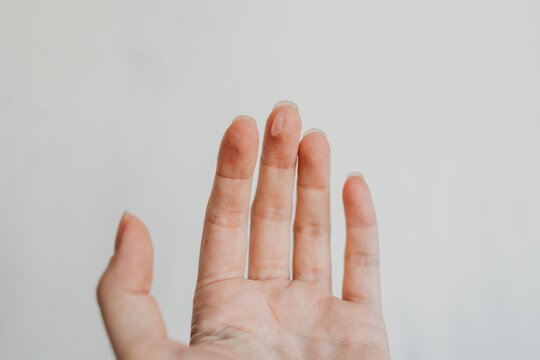 Close-up of a woman&rsquo;s hand with skin irritation on the finger &mdash; real skin texture, dermatology concept