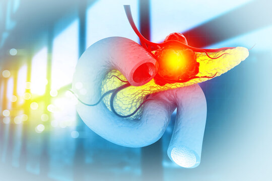 Pancreatic cancer is cancer that forms in the cells of the pancreas. 3d illustration