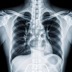 Chest X-ray Showing Ribs, Heart, and Lungs for Medical Diagnosis