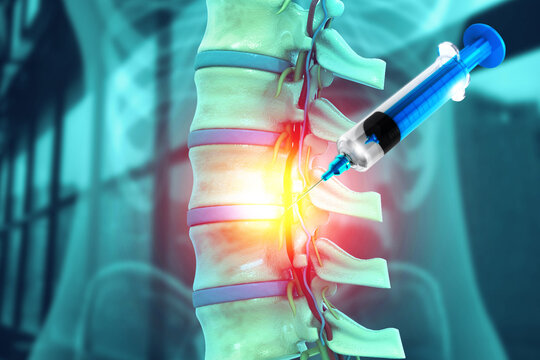 Human spinal cord injury, lumbar spine injection. 3d illustration - Powered by Adobe