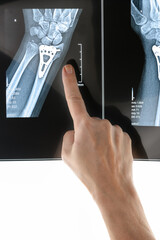 Hand finger points X-ray of hand surgical options for treating a distal radius fracture Inserting a purpose-built orthopaedic plate with open reduction internal fixation frontal and lateral view