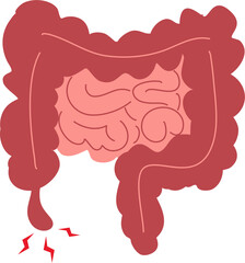Appendicitis illustration