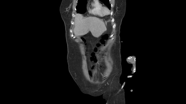 Abdominal CT Showing Spleen and Renal Infarction Caused by Infective Endocarditis